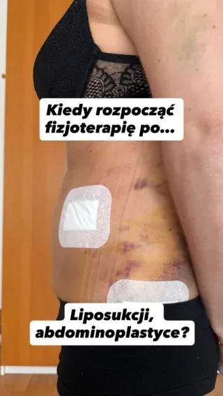 Materiał Fizjonatury o fizjoterapii po liposukcji i abdominoplastyce