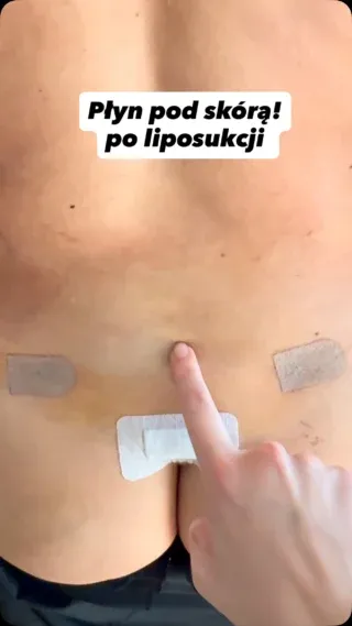 Materiał Fizjonatury wyjaśniający, czym jest płyn pod skórą po liposukcji